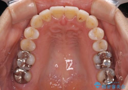 気になる八重歯 ワイヤー装置での非抜歯矯正の治療後