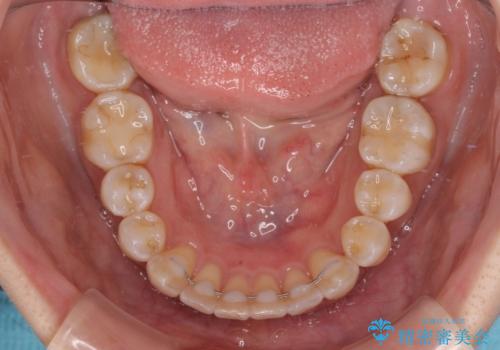 気になる八重歯 ワイヤー装置での非抜歯矯正の治療後