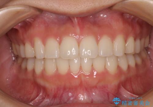 上下前歯のデコボコ ワイヤー装置で楽して改善の治療後