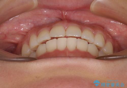 上下前歯のデコボコ ワイヤー装置で楽して改善の治療後