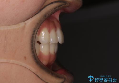 上下前歯のデコボコ ワイヤー装置で楽して改善の治療後