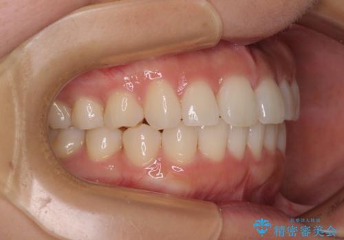 上下前歯のデコボコ ワイヤー装置で楽して改善の治療後