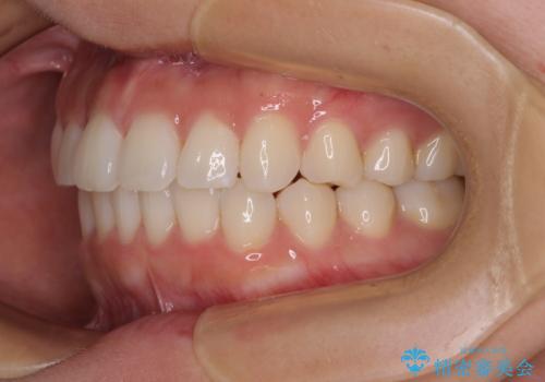 上下前歯のデコボコ ワイヤー装置で楽して改善の治療後