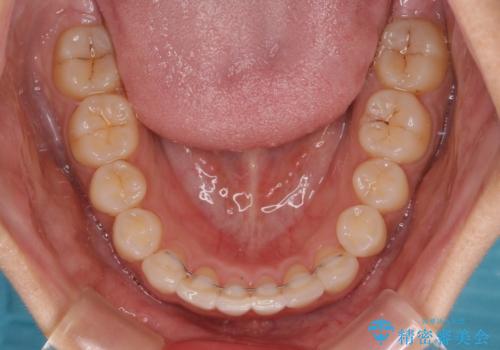 上下前歯のデコボコ ワイヤー装置で楽して改善の治療後