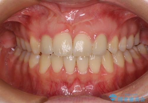 矮小歯と欠損によるずれた位置の大きな歯　オールセラミッククラウンで自然にの治療後