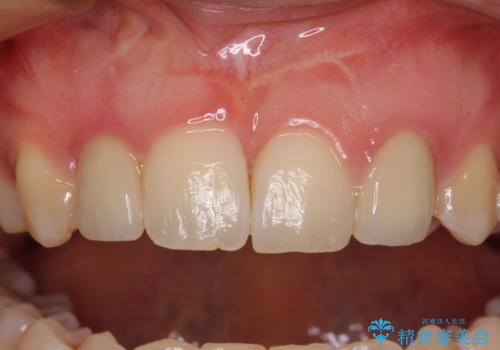 矮小歯と欠損によるずれた位置の大きな歯 オールセラミッククラウンで自然にの治療後