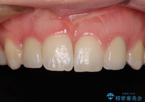 矮小歯と欠損によるずれた位置の大きな歯　オールセラミッククラウンで自然にの症例 治療後