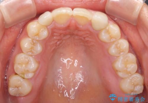 矮小歯と欠損によるずれた位置の大きな歯　オールセラミッククラウンで自然にの治療後