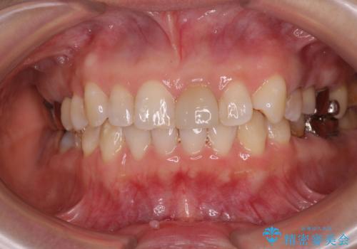 気になる下顎歯列のみをインビザラインで部分矯正の治療後