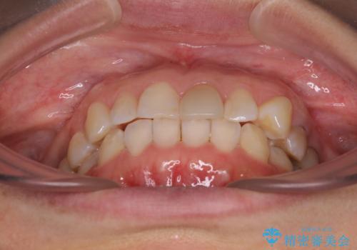 気になる下顎歯列のみをインビザラインで部分矯正の治療後