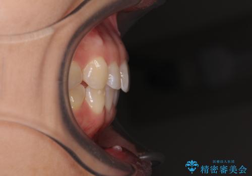 気になる下顎歯列のみをインビザラインで部分矯正の治療後