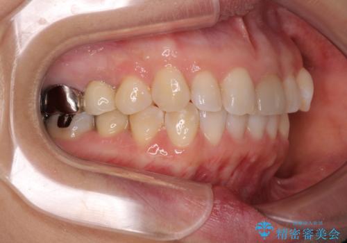 気になる下顎歯列のみをインビザラインで部分矯正の治療後