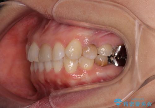 気になる下顎歯列のみをインビザラインで部分矯正の治療後