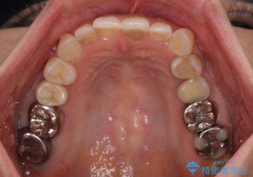 気になる下顎歯列のみをインビザラインで部分矯正の治療後