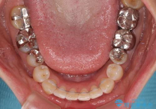 気になる下顎歯列のみをインビザラインで部分矯正の治療後