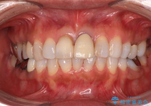 色の不釣り合いな前歯　オールセラミッククラウンで調和の取れた前歯にの治療前