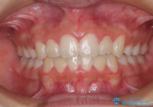 気がつくと唇があいてしまう ワイヤー装置での抜歯矯正の症例 治療後