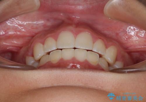 気がつくと唇があいてしまう ワイヤー装置での抜歯矯正の治療後