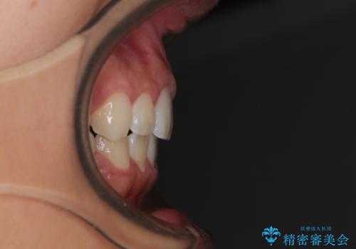 気がつくと唇があいてしまう ワイヤー装置での抜歯矯正の治療後