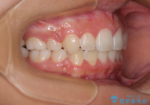 気がつくと唇があいてしまう ワイヤー装置での抜歯矯正の治療後