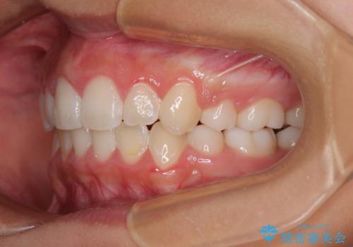 気がつくと唇があいてしまう ワイヤー装置での抜歯矯正の治療後