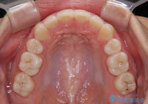 気がつくと唇があいてしまう ワイヤー装置での抜歯矯正の治療後