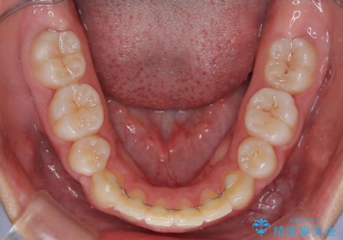 気がつくと唇があいてしまう ワイヤー装置での抜歯矯正の治療後