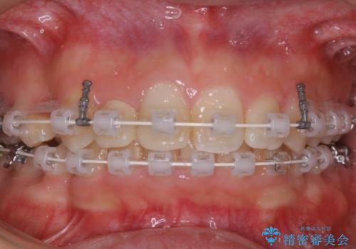 前歯の不自然なセラミック 下のすきっ歯 矯正治療で総合的に美しくの治療中