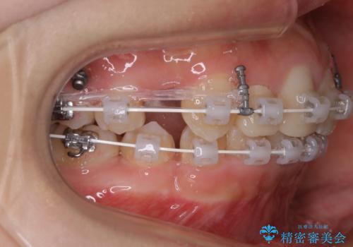 前歯の不自然なセラミック　下のすきっ歯　矯正治療で総合的に美しくの治療中