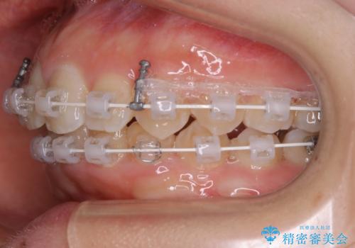 前歯の不自然なセラミック 下のすきっ歯 矯正治療で総合的に美しくの治療中