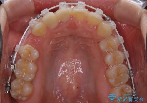 前歯の不自然なセラミック 下のすきっ歯 矯正治療で総合的に美しくの治療中