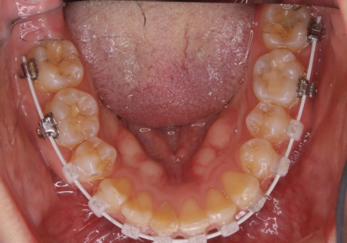 前歯の不自然なセラミック　下のすきっ歯　矯正治療で総合的に美しくの治療中