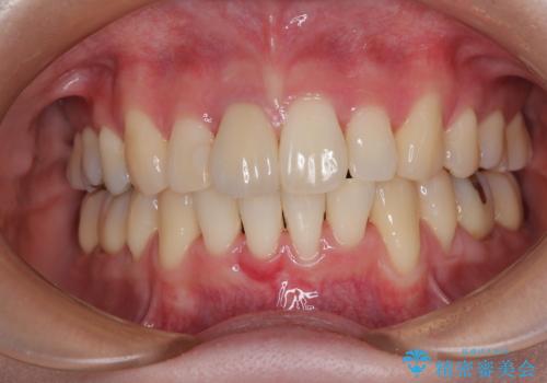 気になる出っ歯を治したい 抜歯矯正でスッキリした横顔に