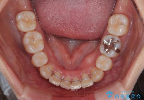 気になる出っ歯を治したい 抜歯矯正でスッキリした横顔にの治療後