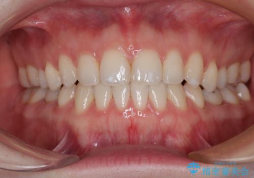 すきっ歯をインビザラインできれいな歯並びに改善の症例 治療後