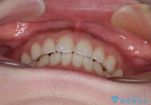 すきっ歯をインビザラインできれいな歯並びに改善の治療後