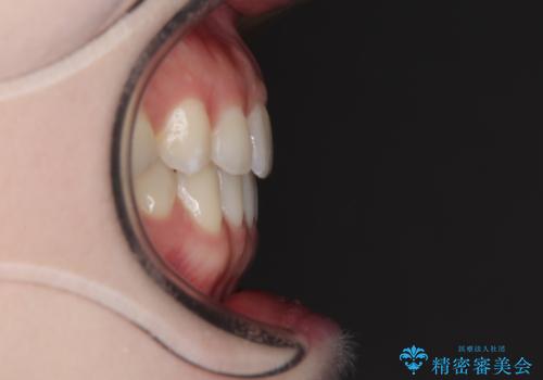 すきっ歯をインビザラインできれいな歯並びに改善の治療後