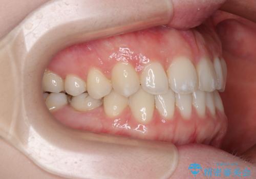 すきっ歯をインビザラインできれいな歯並びに改善の治療後