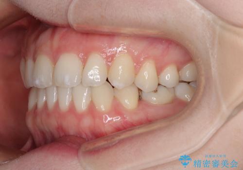 すきっ歯をインビザラインできれいな歯並びに改善の治療後