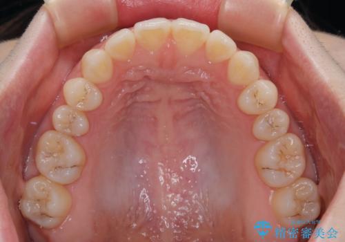すきっ歯をインビザラインできれいな歯並びに改善の治療後