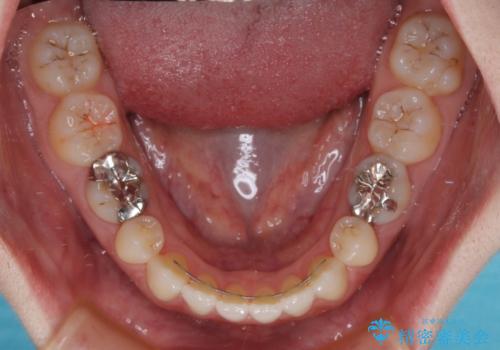 すきっ歯をインビザラインできれいな歯並びに改善の治療後