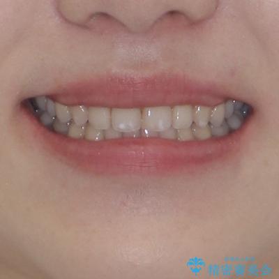 すきっ歯をインビザラインできれいな歯並びに改善の治療後（顔貌）