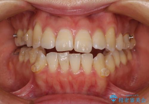 八重歯と開咬の抜歯矯正　ワイヤー装置を併用したインビザライン矯正治療の治療中
