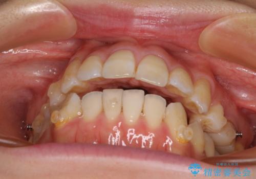 八重歯と開咬の抜歯矯正 ワイヤー装置を併用したインビザライン矯正治療の治療中
