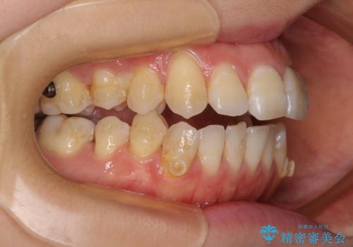 八重歯と開咬の抜歯矯正　ワイヤー装置を併用したインビザライン矯正治療の治療中