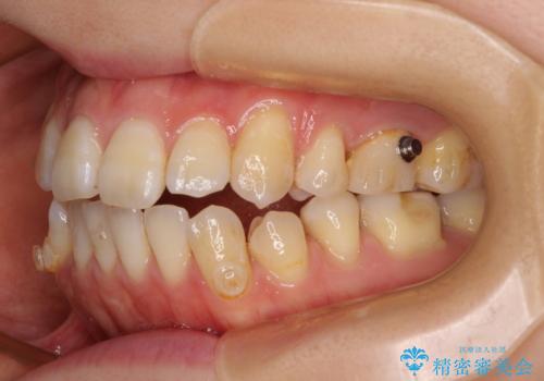 八重歯と開咬の抜歯矯正 ワイヤー装置を併用したインビザライン矯正治療の治療中