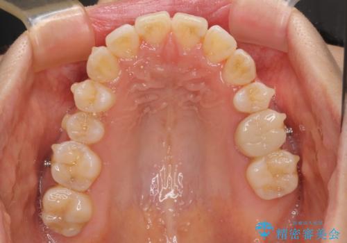 八重歯と開咬の抜歯矯正 ワイヤー装置を併用したインビザライン矯正治療の治療中