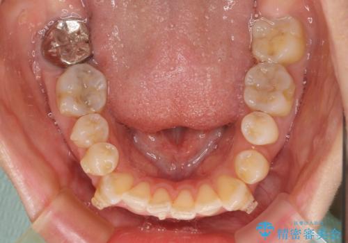 八重歯と開咬の抜歯矯正 ワイヤー装置を併用したインビザライン矯正治療の治療中