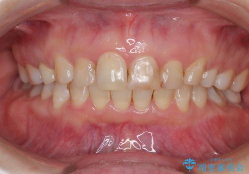 ハーフリンガルで歯列をきれいに　セラミック治療で気になる銀歯も自然な色にの症例 治療後