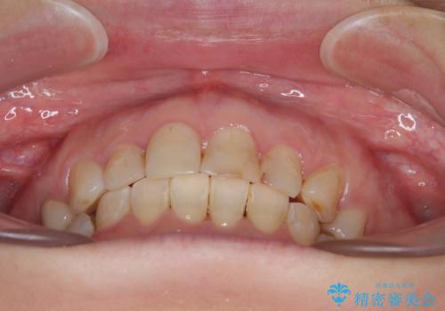 ハーフリンガルで歯列をきれいに セラミック治療で気になる銀歯も自然な色にの治療後